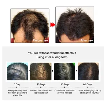 ARTISCARE Plaukų Augimą eterinis Aliejus Kovos su Plaukų Slinkimas Skystis Plaukų Remontas Gydymas Tankus Moterų, Vyrų Plaukų Serumas